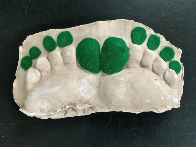 Image of toes cast